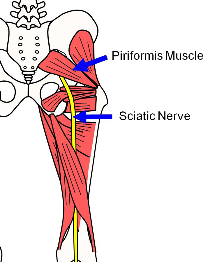 What To Do For Sciatica Pain In Leg